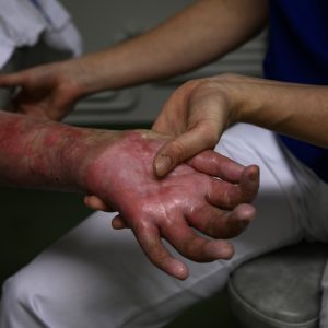 Patient and therapist during physiotherapist session to recovery from her burn wounds at Sunnaas Rehabilitation Hospital. Sunnaas Rehabilitation Hospital is a hospital in Nesodden, Norway, and a health trust under Helse Sør-Øst. Sunnaas is the country's largest specialized hospital in physical medicine and rehabilitation. Patient services include cancer services, brain injuries after accidents or disease, multiple injuries, burns, and neurology. The rehabilitation program covers primary rehabilitation, controlled return, and patient programs. The hospital has policlinics in Oslo and on Nesodden and runs laboratory research on the hospital's behalf. Research is a central part of the trust's work. Research is a central part of the trust's work. The hospital has its own research department and uses both medical students and their own health personnel.